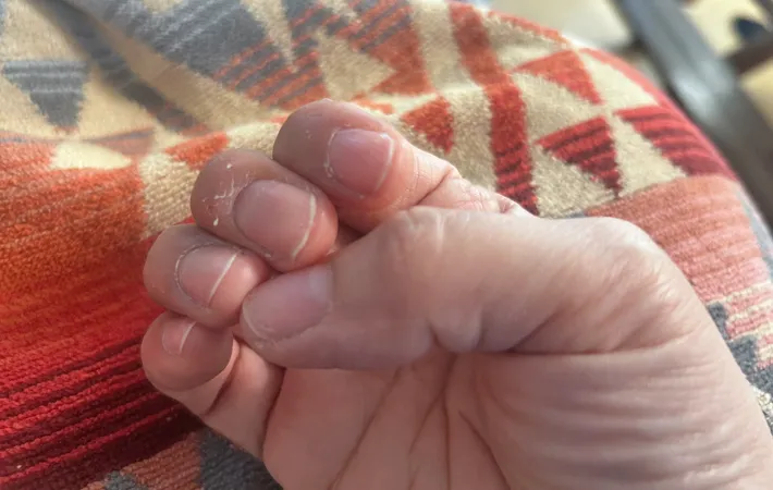 荒れた手指の写真（撮影：エニママ）